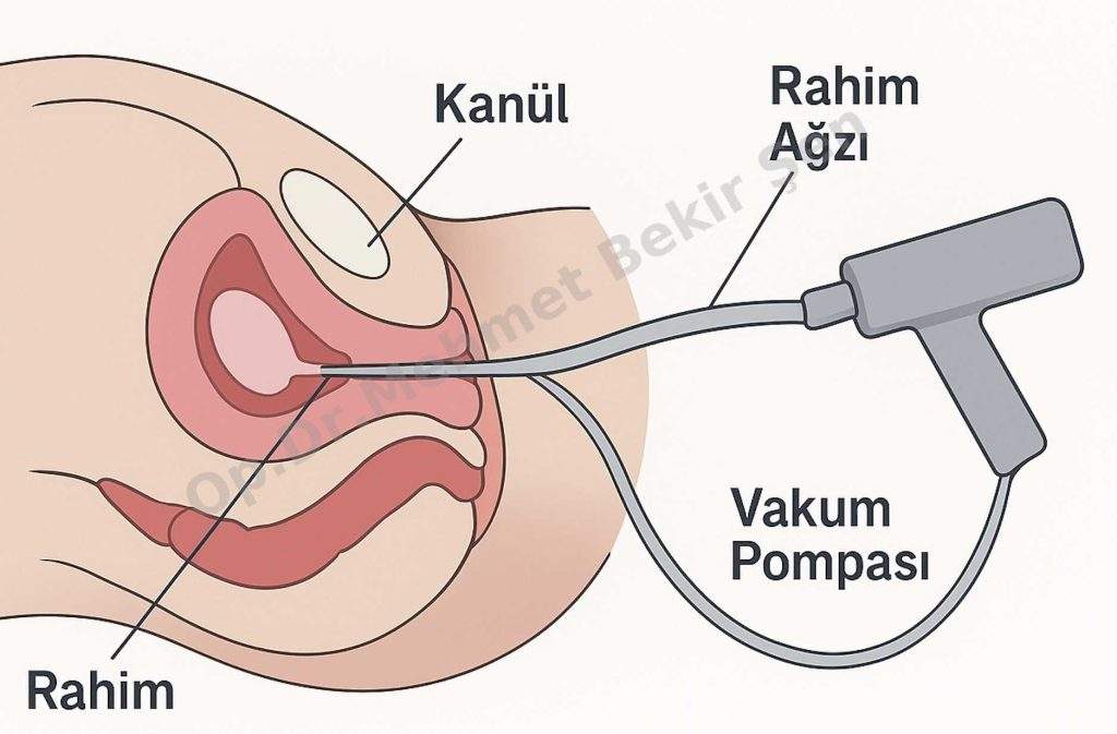 kürtaj ankara